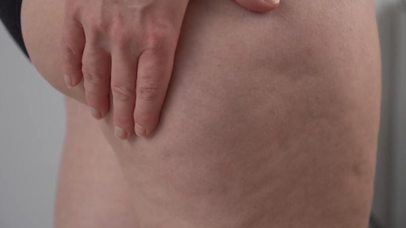 Žena dodiruje rukom celulit na butini i zadnjici